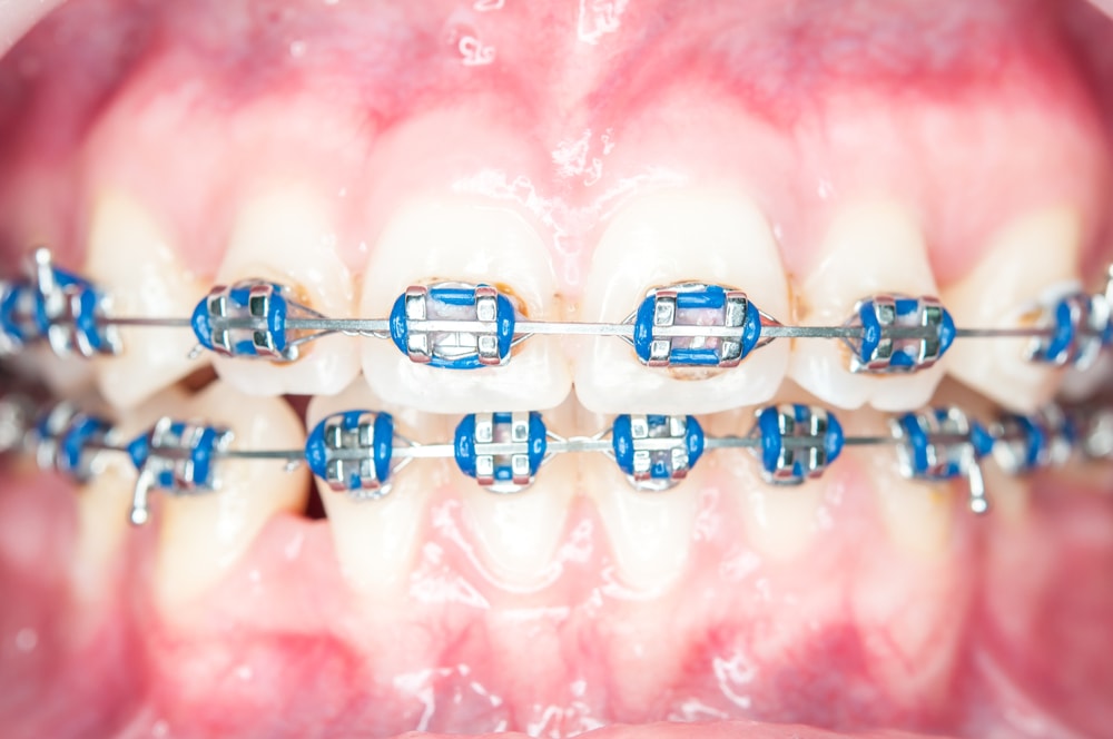 Teeth with braces - Sutton Place Dental Associates