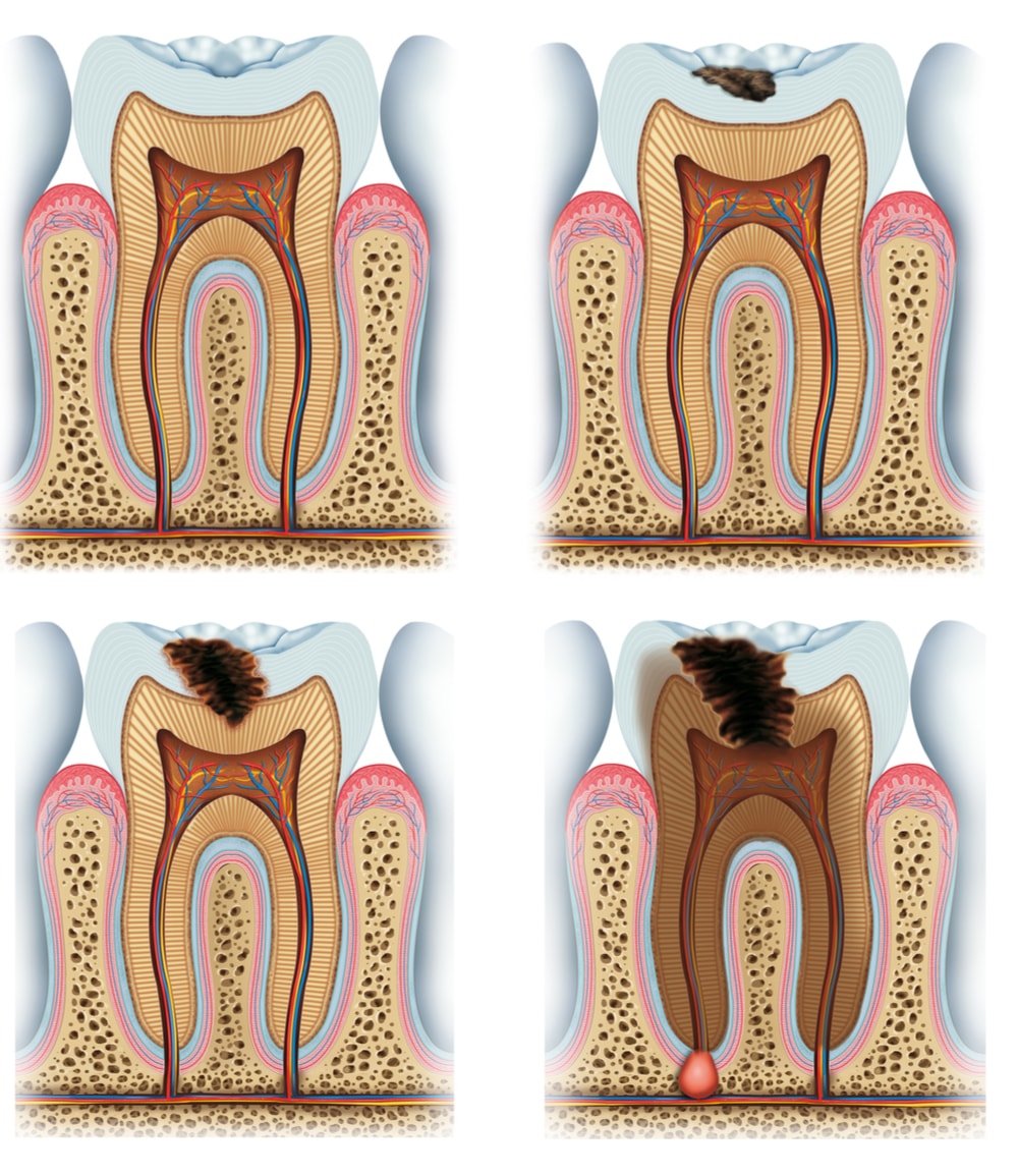 Sensitivity Gums Irritation After Teeth Whitening The Definitive 