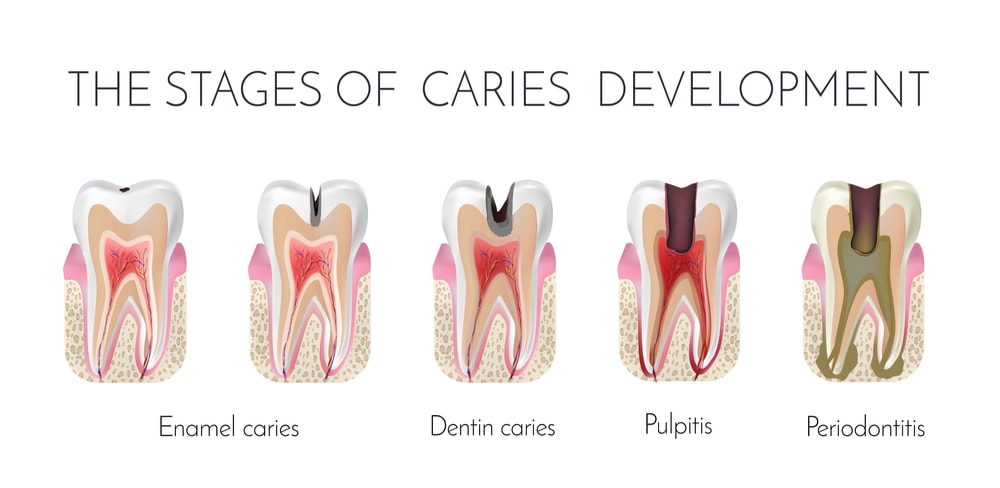 stages-of-caries-formation-enamel-caries-dentin-caries-pulpitis