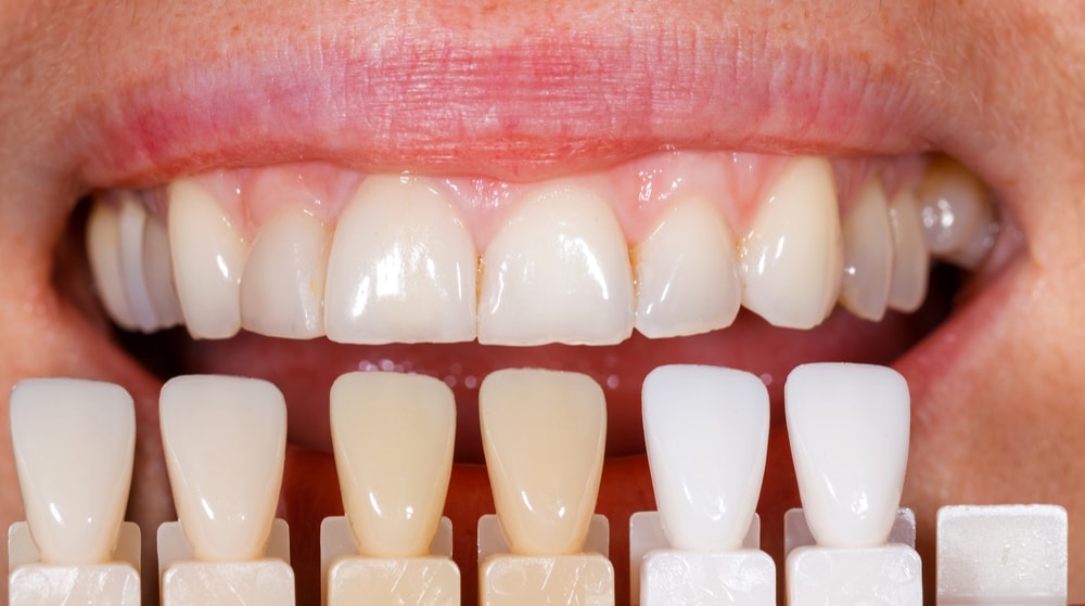 Teeth Whitening Results The Definitive Guide For 2022