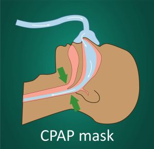 Unoccluded airflow with CPAP mask