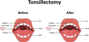 Tonsillectomy - Sutton Place Dental Associates