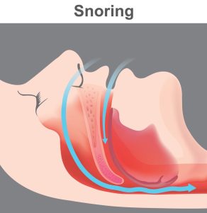 Snoring 