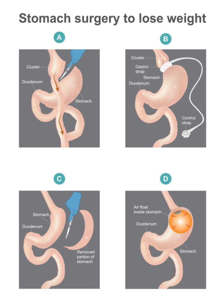 Different types of bariatric surgery procedures Sutton