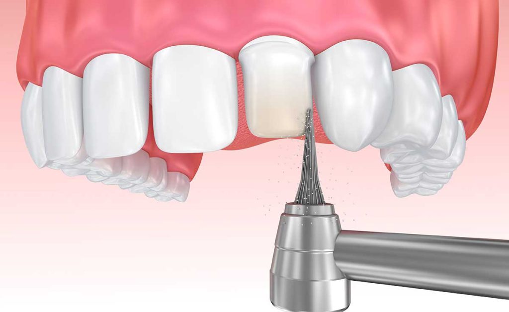 Image showing enamel shaving before placing a porcelain veneer