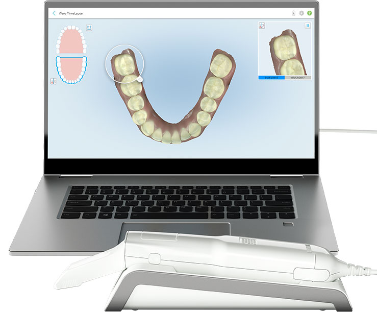 ITERO SCANNER