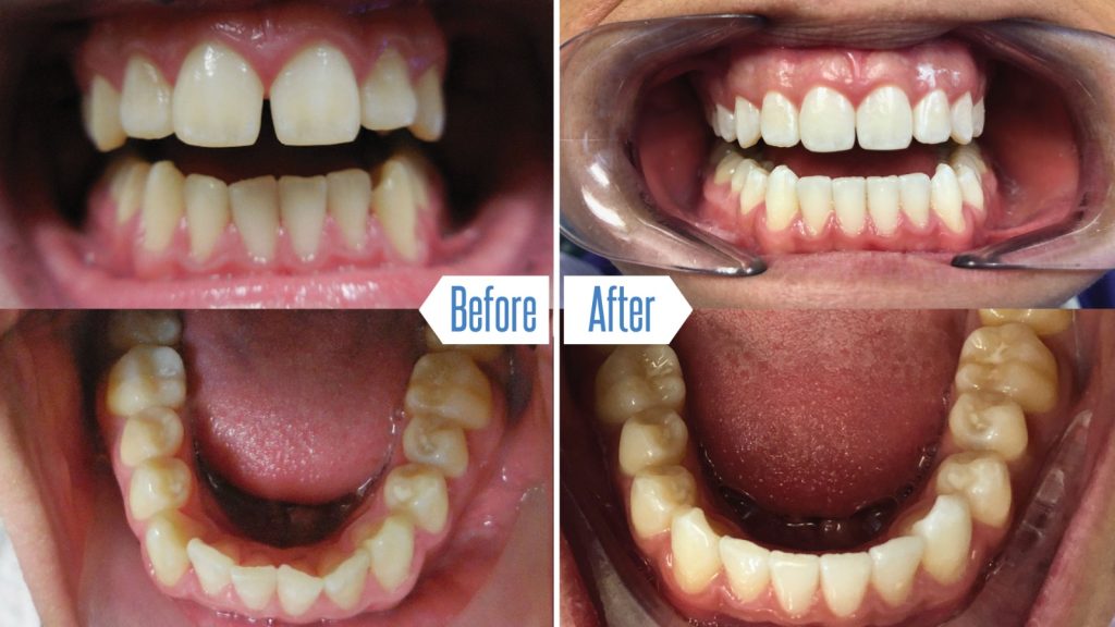 Invisalign before and after photos