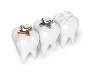 Dental Fillings: Tooth-Colored, Gold, and Porcelain Options