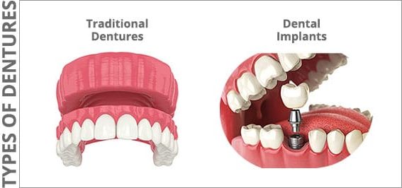 Traditional dentures versus dental implants diagram.