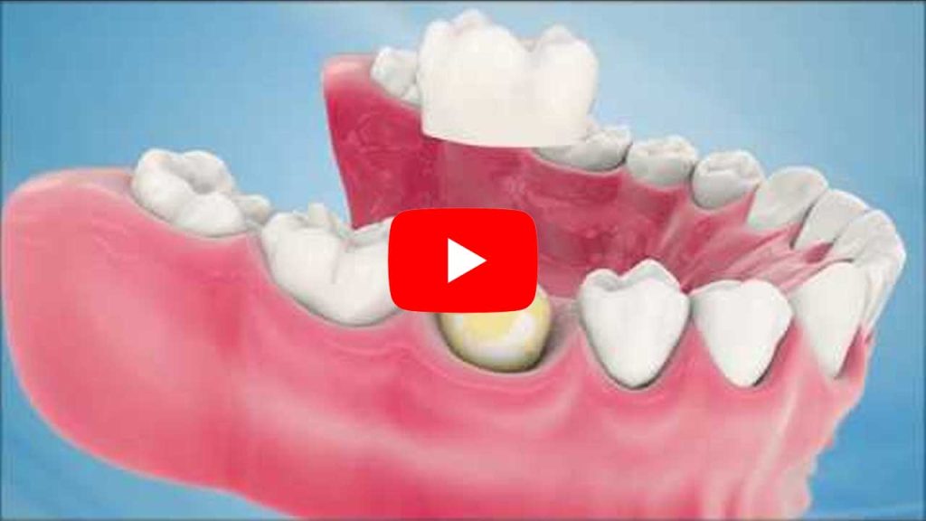 YouTube Video: Dental Crown Procedure