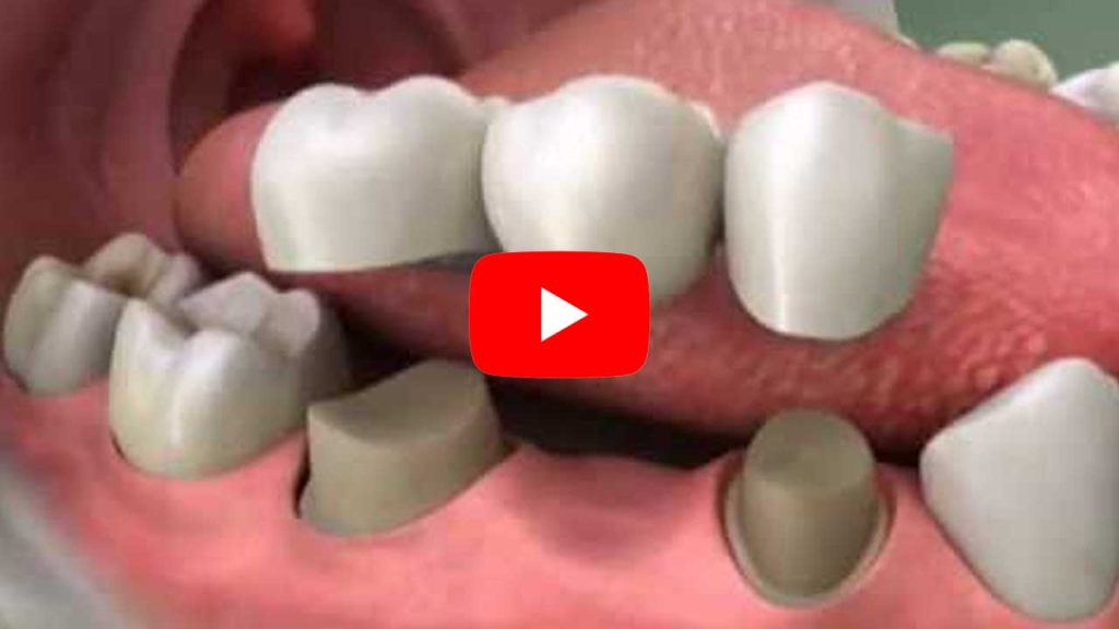 YouTube Video of Tooth Bridge 3 Unit Bridge - Roseville Dentist