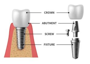 Front teeth dental implants diagram.