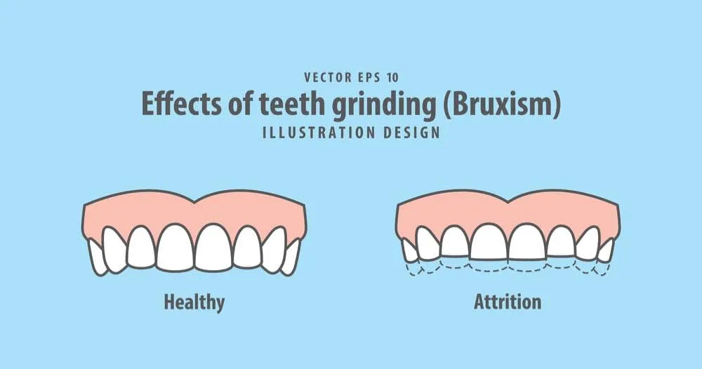 Effects of teeth grinding (bruxism)