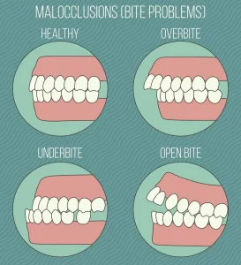 Malocclusion problems, bad bite