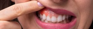 Swelling, bleeding and receding gums